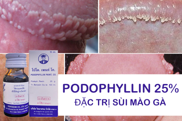 Nơi bán Thuốc Podophyllin 25 Thái Lan chữa trị sùi mào gà tại nhà cho nam nữ chính hãng Nơi bán Thuốc Podophyllin 25 Thái Lan chữa trị sùi mào gà tại nhà cho nam nữ chính hãng
